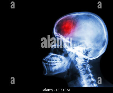 Stroke . il film x-ray del cranio e della colonna vertebrale cervicale vista laterale e corsa . accidente cerebrovascolare . La zona vuota a sinistra . Foto Stock