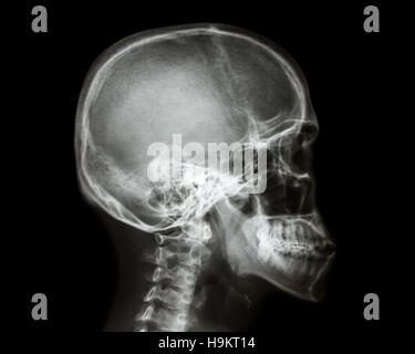 Film x-ray del cranio e della colonna vertebrale cervicale vista laterale Foto Stock