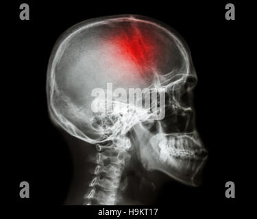 Stroke . il film x-ray cranio vista laterale mostra teschio umano e corsa . accidente cerebrovascolare . sfondo isolato Foto Stock