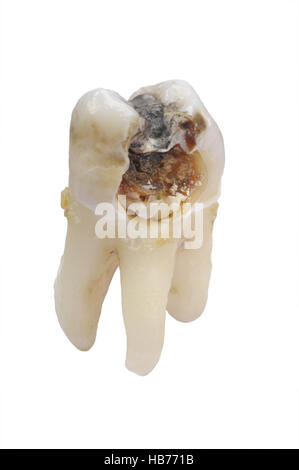 Dente estratto con la carie Foto Stock