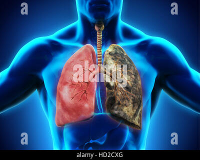 Polmone sano e il polmone per fumatori Foto Stock