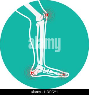 Gamba umana zone di dolore. Gli elementi di design per una infografica. Illustrazione Vettoriale. Illustrazione Vettoriale