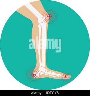 Gamba umana zone di dolore. Gli elementi di design per una infografica. Illustrazione Vettoriale. Illustrazione Vettoriale