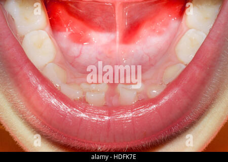 Bambino la bocca con denti di bambino e cresciuto denti sia sul fondo incisivi questo è noto come denti di squalo Foto Stock