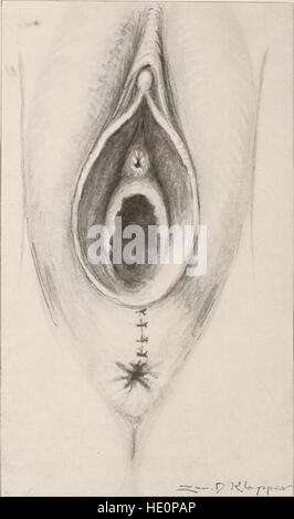 Le *Transactions of the American Association of Obstetricians and Gynecologists* (1919) contengono articoli accademici e ricerche incentrate su ostetricia e ginecologia, affrontando progressi medici, trattamenti e tecniche per la salute delle donne. Foto Stock