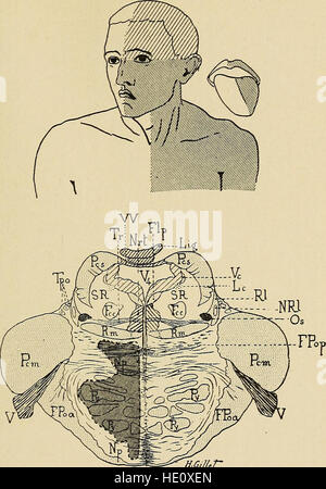 Malattie del sistema nervoso - un libro di testo di Neurologia e psichiatria (1915) Foto Stock