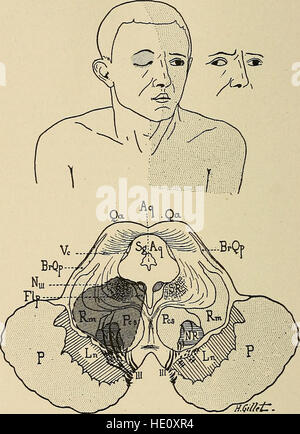 Malattie del sistema nervoso - un libro di testo di Neurologia e psichiatria (1915) Foto Stock