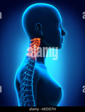 Dolorose della colonna vertebrale cervicale Foto Stock