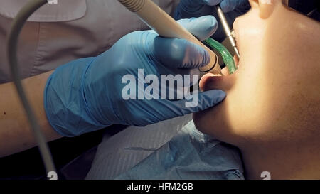 Donna dente ad ultrasuoni odontolith placca rimozione Foto Stock