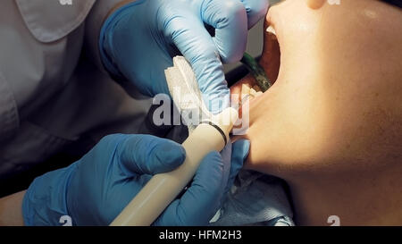 Donna dente ad ultrasuoni odontolith placca rimozione Foto Stock