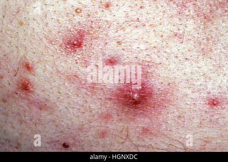 ACNE Foto Stock