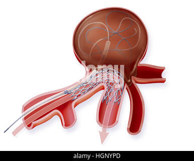 Trattamento dell'aneurisma Foto Stock
