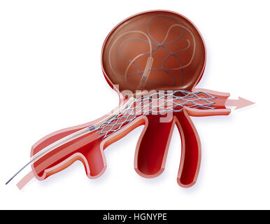 Trattamento dell'aneurisma Foto Stock