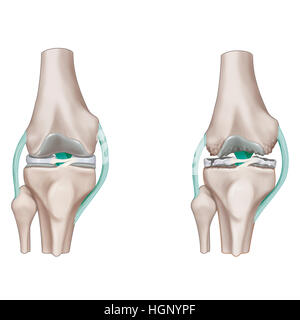 Osteoartrite DEL GINOCCHIO, illustrazione Foto Stock