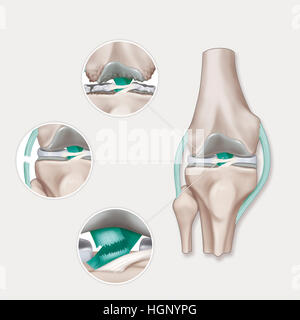 Lesioni del ginocchio, illustrazione Foto Stock