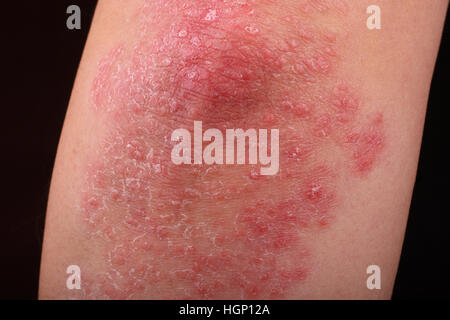 Psoriasi su un gomito che mostra il rossore e asciugare le patch. Foto Stock