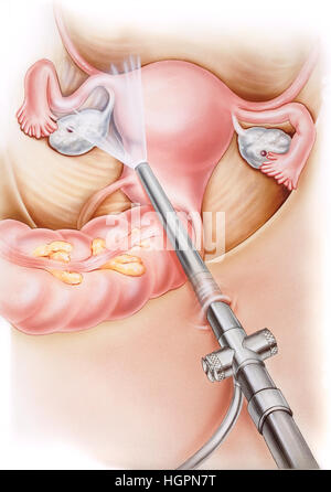 Utero - laparoscopia, in cui una piccola incisione viene effettuata in addome e il laparoscopio è inserito in vista interno organi femmina. Le ovaie, fa Foto Stock