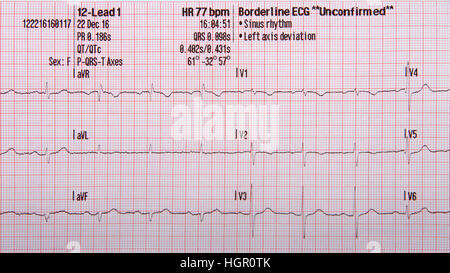 12 lead tracciato ECG che mostra il normale ritmo sinusale con voci non confermate la deviazione assiale sinistra Foto Stock