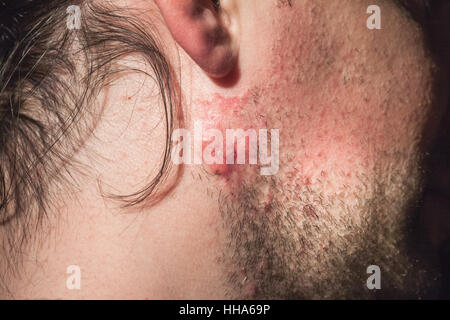 Il cancro della pelle vicino fino sulla guancia uomo Foto Stock