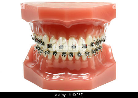 Modello di denti con metallo cablata bretelle dentali isolati su sfondo bianco Foto Stock