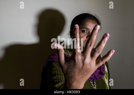 India, Calcutta, donne vittime attacco acido, ritratto Foto Stock