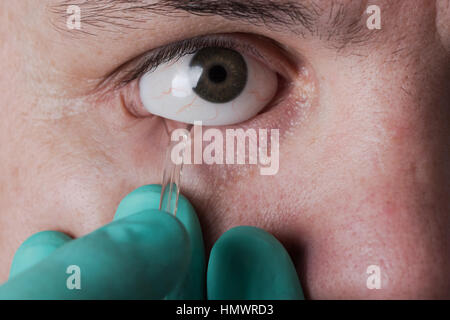 Occhio di vetro protesico per estrazione della protesi oculari Foto Stock