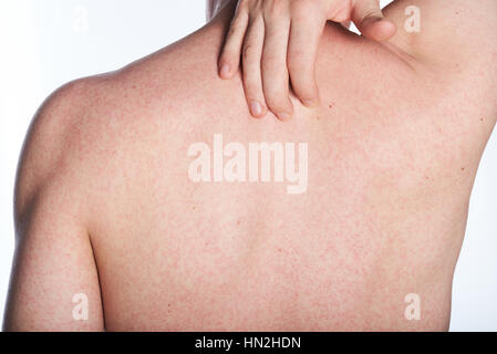 Allergy rash sul retro dell uomo isolato su bianco Foto Stock