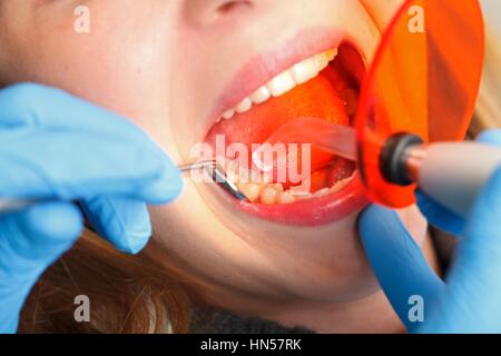 Dentista lavora con polimerizzazione dentale lampada nella cavità orale Foto Stock