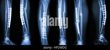 Raccolta di immagini di frattura della gamba e il trattamento chirurgico mediante la fissazione interna con la piastra e la vite . Rompere la tibia e perone osso . Foto Stock