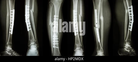 Raccolta di immagini di frattura della gamba e il trattamento chirurgico mediante la fissazione interna con la piastra e la vite . Rompere la tibia e perone osso . Foto Stock