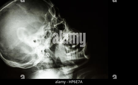 Film X-ray di normale teschio umano . vista laterale . La zona vuota a destra . Foto Stock