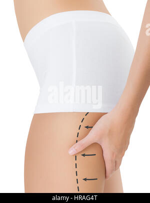 Donna di spremitura coscia posteriore con il disegno frecce nere, perdere peso e liposuzione cellulite distacco concetto, isolati su sfondo bianco. Foto Stock