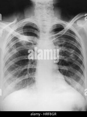 X-ray del linfoma di Hodgkin Foto Stock