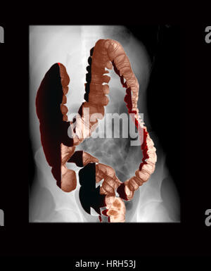 Doppio normale contrasto Enema del bario Foto Stock