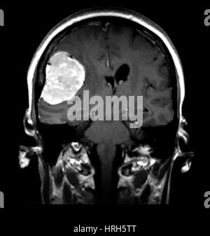 Sul lato destro il meningioma Foto Stock