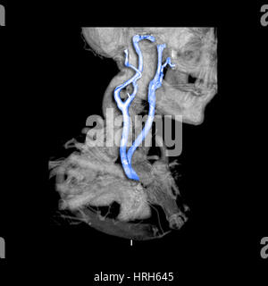 Colore 3D avanzato CTA di arterie carotidee Foto Stock