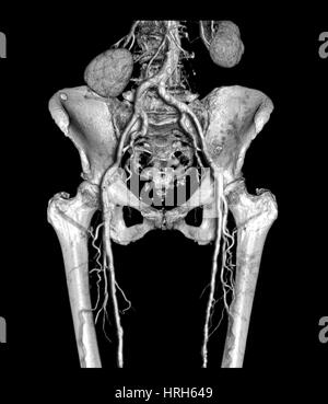 Il bacino e la parte superiore delle gambe con arteriosclerosi Foto Stock