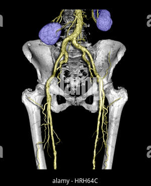 Il bacino e la parte superiore delle gambe con arteriosclerosi Foto Stock