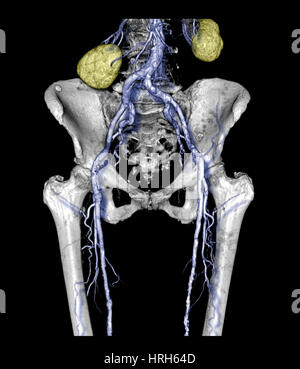 Il bacino e la parte superiore delle gambe con arteriosclerosi Foto Stock