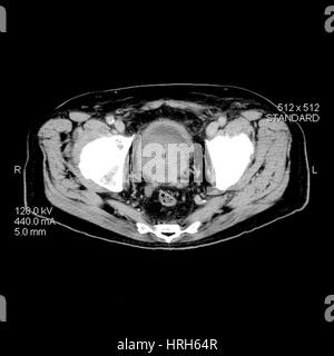 CT del cancro della prostata Foto Stock