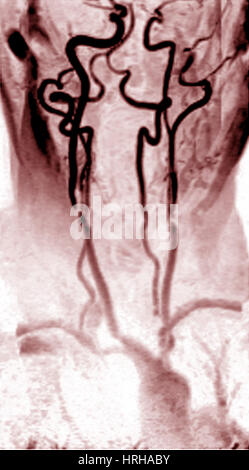 Stenosi della carotide interna le arterie Foto Stock
