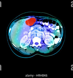 Scansione TC di un tumore del fegato Foto Stock