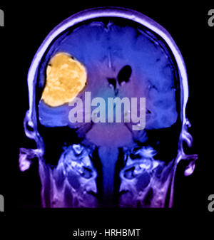 Sul lato destro il meningioma Foto Stock