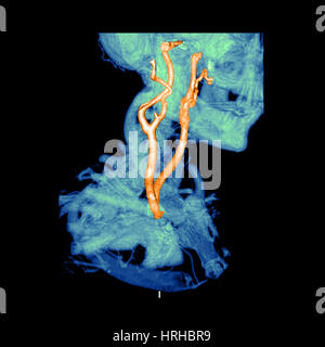 3D CTA di arterie carotidee Foto Stock