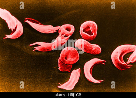 Anemia falciforme, SEM Foto Stock