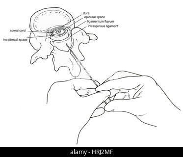 Illustrazione della puntura lombare (Spinal Tap) Foto Stock