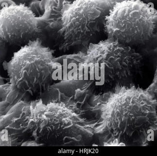 Leucemia a cellule capellute, SEM Foto Stock