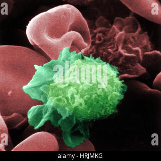 Leucemia a cellule capellute, SEM Foto Stock