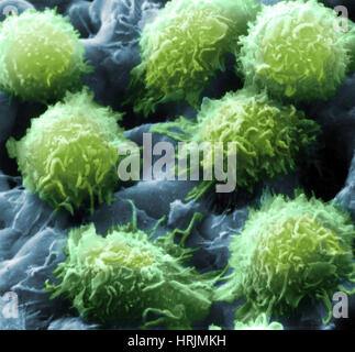 Leucemia a cellule capellute, SEM Foto Stock