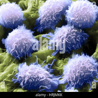 Leucemia a cellule capellute, SEM Foto Stock